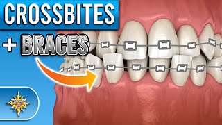 How Do BRACES Fix Crossbites [upl. by Lynda695]