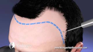 NeoGraft Michigan Hair Restoration [upl. by Holton]