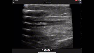 USM  Catheter Thrombi [upl. by Shanahan510]