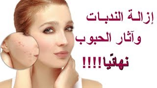 كريم رائع لإزالة آثار الحبوب والجروح بأقل من20dh [upl. by Brendan653]