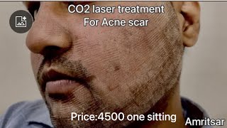 I got franctional CO2 Laser Treatment for Acne Scars  first sitting  Before After Results [upl. by Selie]