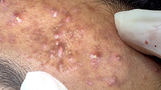 SJ 634 Great Extraction Blackheads And Inflamed Acne [upl. by Denice759]