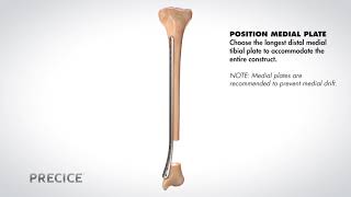 PRECICE® Plate Assisted Bone Transport Animation [upl. by Middlesworth]