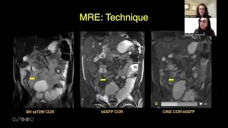 CT Versus MR Enterography PointCounterpoint [upl. by Erna]