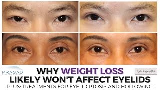 Why Weight Loss Wont Likely Affect Upper Eyelid Position or Cause Hollowing [upl. by Emmett]