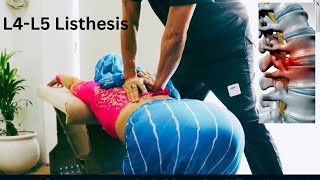 HOW TO TREAT BACKPAINL4L5 Anterolisthesis Best Chiropractor in India Immediate relief [upl. by Lirrad650]