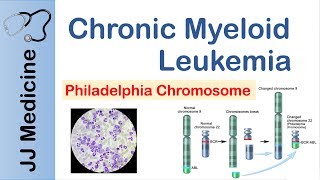 Chronic Myeloid Leukemia CML  Pathogenesis Symptoms and Treatment [upl. by Ojibbob]