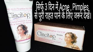 Clincitop Gel For Acne Pimples Remover Full Review By Anmol Hindi [upl. by Rie371]