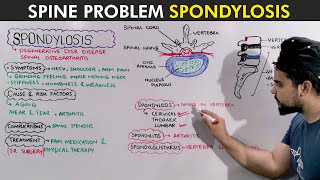 Spondylosis Symptoms Causes and Treatment [upl. by Eikin]