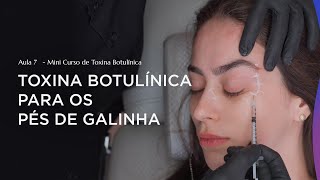 Aula 7  Como melhorar os Pés de Galinha com Toxina Botulínica [upl. by Neret634]