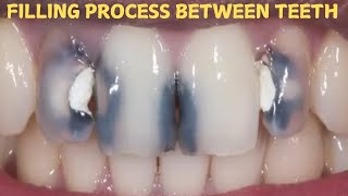 Front teeth filling process  composite filling  cavity filling  teeth damage repair [upl. by Ellenoj]