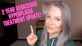 Sebaceous Hyperplasia Update Did they ever come back Whats my best advice for treatment [upl. by Anesusa]