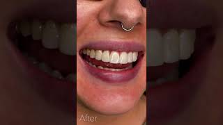 Composite Bonding Smile Makeover compositebonding smiledentist smile dentist [upl. by Tarrah]