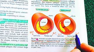 Atherosclerosis Robbins Pathology Atherosclerosis vs Arteriosclerosis  Atherosclerosis Pathology [upl. by Hirz678]