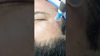 Dermapen Microneedling for acne scars  Dermalyn Aesthetics  Dr Muskan Tyagi [upl. by Johanan]