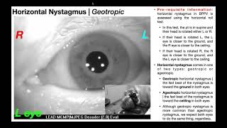 Nystagmus EXPLAINED 👀  Visualizing amp Interpretation [upl. by Bellanca]