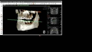 TOMOGRAFIA Diente retenido Ez3D Plus 2024 ODONTO [upl. by Aklam]