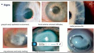 interstitial keratitis cogan syndrome acanthamoeba keratitis [upl. by Crissie]