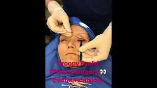 Droopy Upper Eyelids Ptosis Surgery [upl. by Tareyn]