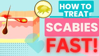 HOW TO TREAT SCABIES FAST TREATMENT AND HOME REMEDIES [upl. by Aikem]