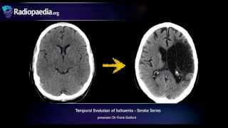 Stroke Evolution from acute to chronic infarction  radiology video tutorial CT MRI [upl. by Irafat192]