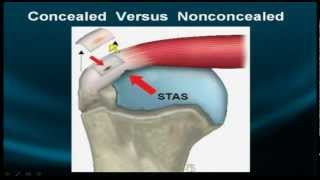 Shoulder MRI Rotator Cuff  Part IIa [upl. by Bonny]