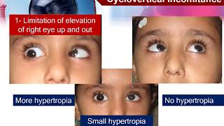 13 Motor evaluation of strabismus Comitant and noncomitant strabismus [upl. by Bromleigh641]