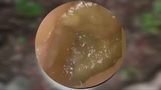 Ear cleaning wax removal ep 16 [upl. by Damick]