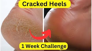 Cracked Heels 1 Week Challenge  Quick Cracked Heel Treatment [upl. by Sissy]