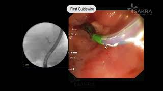 ERCP Procedure Video  Best Gastroenterologist in Bangalore  Dr Dinesh Kini  Sakra World Hospital [upl. by Mallin]