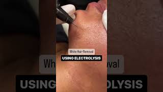 Electrolysis Hair Removal [upl. by Sirovaj]