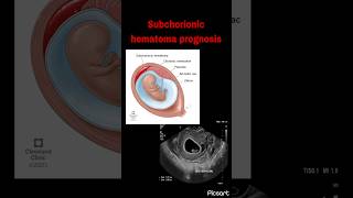 Subchorionic hematoma prognosis  Miscarriage rate following vaginal bleeding in pregnancy [upl. by Dasteel]