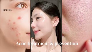 Acne treatment amp Prevention  acne scars  pimples  blackheads  cysts [upl. by Masterson]