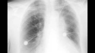 Left Upper Lobe Atelectasis on Chest X ray [upl. by Verene]