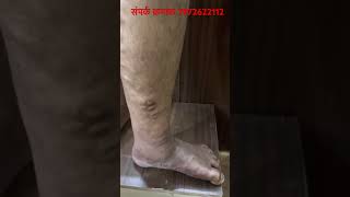 Varicose Veins  Laser Treatment of Varicose veins [upl. by Aciria737]