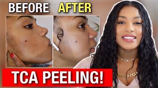 How To TCA Peel  Step by Step Tutorial [upl. by Inneg507]