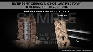 Emergent Cervical C3C6 Laminectomy Decompression amp Fusion  Medical Animation [upl. by Crim]