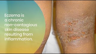 Treating and Managing Eczema in All Skin of Colors [upl. by Mendel10]