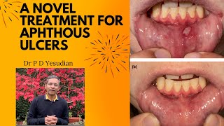 A new treatment for apththous ulcers canker sores [upl. by Slin]