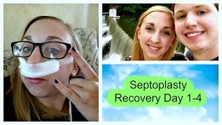 Septoplasty Recovery Day 14 [upl. by Annayk]