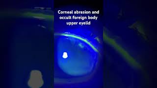 Corneal abrasion and occult foreign body under the upper eyelid protectingsight ophthalmology [upl. by Havstad502]