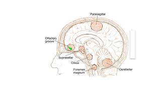 Meningiomas Signs Symptoms and Advanced Treatment Options [upl. by Travus]