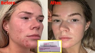 Acnesol Gel For Permanent Acne Pimples Removal 🔥  Usefull Products [upl. by Zicarelli44]