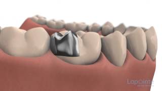 Incrustation  Centres dentaires Lapointe [upl. by Aaberg]