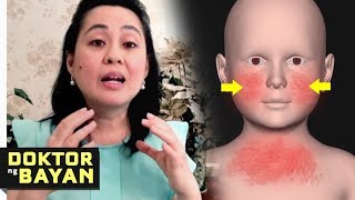 ECZEMA Tamang Gamutan  Doc Liza RamosoOng Health Tips 10b [upl. by Marice]