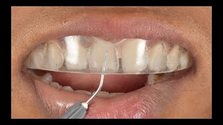 Direct composite veneers  Injection moulding technique  Complete Digital Workflow [upl. by Yahs67]