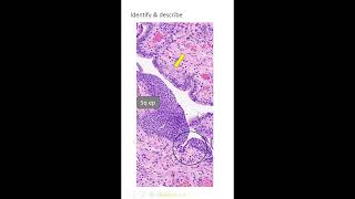 Exam slides squamous epithelial lesions set 21 Dr GSS SRM MCH RC [upl. by Elraet]