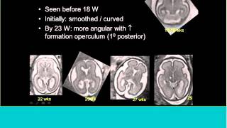 Topics in Fetal Medicine  Gilbert Vezina MD FACR [upl. by Zacarias11]