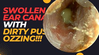 Narrow SWOLLEN Ear Canal With PUS Oozing [upl. by Berke699]