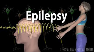 Epilepsy Types of seizures Symptoms Pathophysiology Causes and Treatments Animation [upl. by Alia]